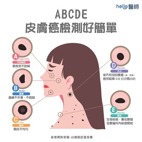 臉部有痣|痣變大、痣多或長毛會變皮膚癌？認識痣的形成與原因